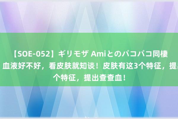 【SOE-052】ギリモザ Amiとのパコパコ同棲生活 Ami 血液好不好，看皮肤就知谈！皮肤有这3个特征，提出查查血！